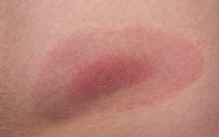 Erythema migrans